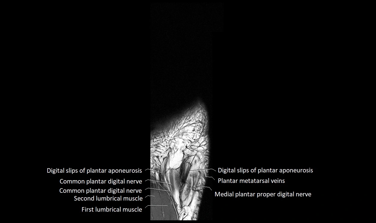 Great Toe micro anatomy MRI axial cross sectional 3T image 27.webp